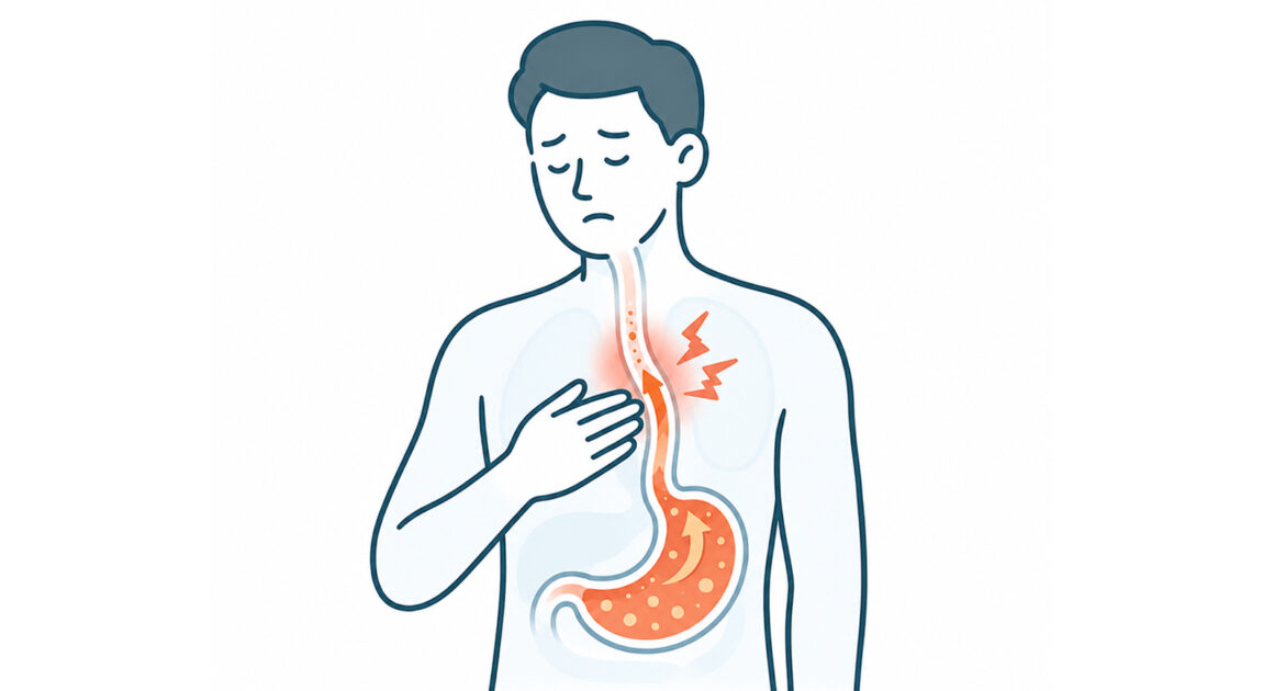 胸やけ・胃酸逆流・逆流性食道炎の症状を示した医療イラスト。調布おなかと内科のクリニックでは、食道や胃の状態を確認する胃カメラ検査に対応しています。