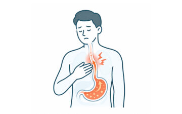 胸やけ・胃酸逆流・逆流性食道炎の症状を示した医療イラスト。調布おなかと内科のクリニックでは、食道や胃の状態を確認する胃カメラ検査に対応しています。